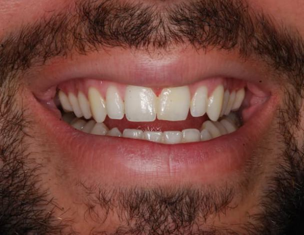 resultados carillas dentales almeria