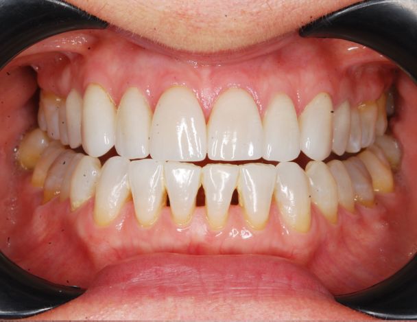 carillas dentales dentista almeria
