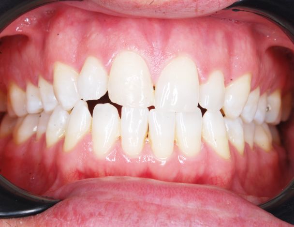 resultado blanqueamiento clinica dental aguadulce