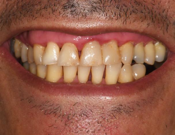 antes implantes dentales clinica eva aguadulce