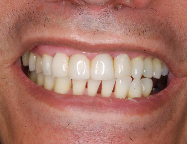 resultado implantes dentales aguadulce