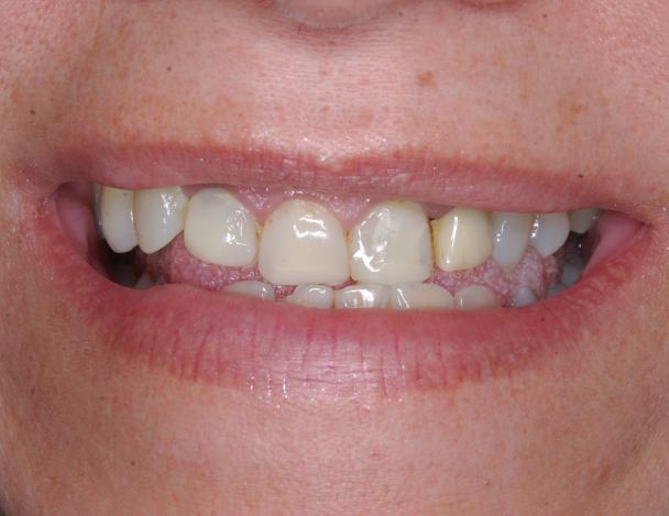 coronas dentales resultados