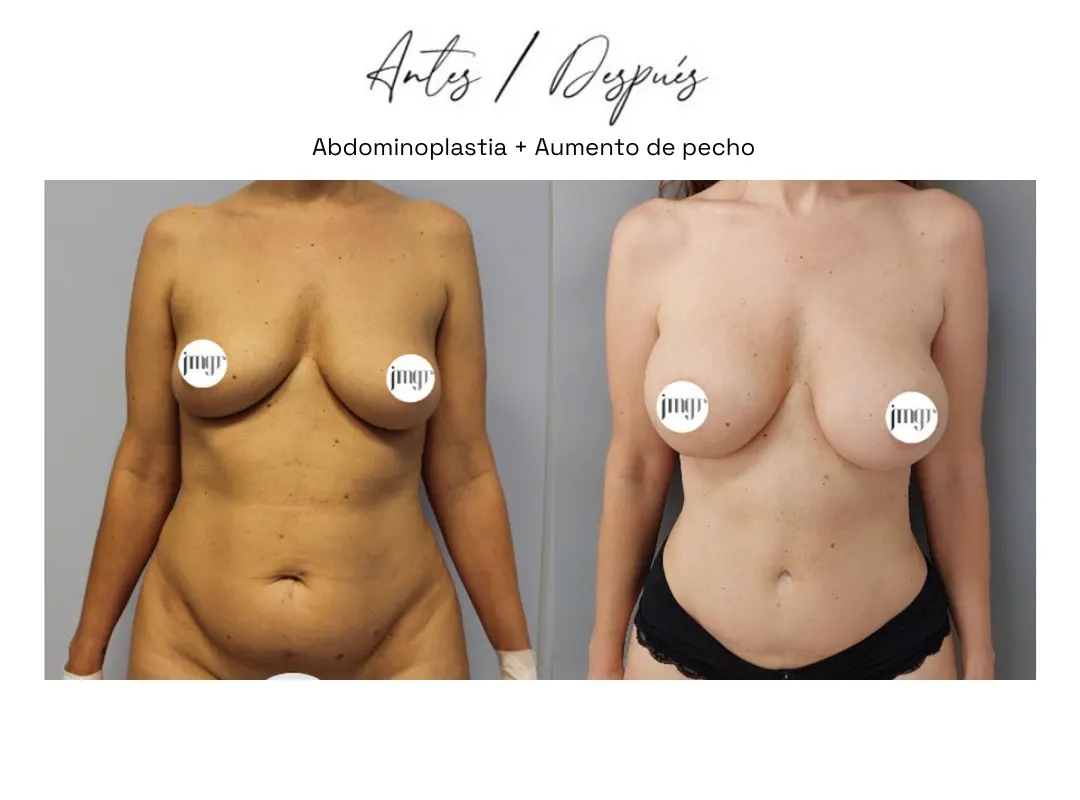 Abdominoplastia antes y despues (2) clinica eva almeria