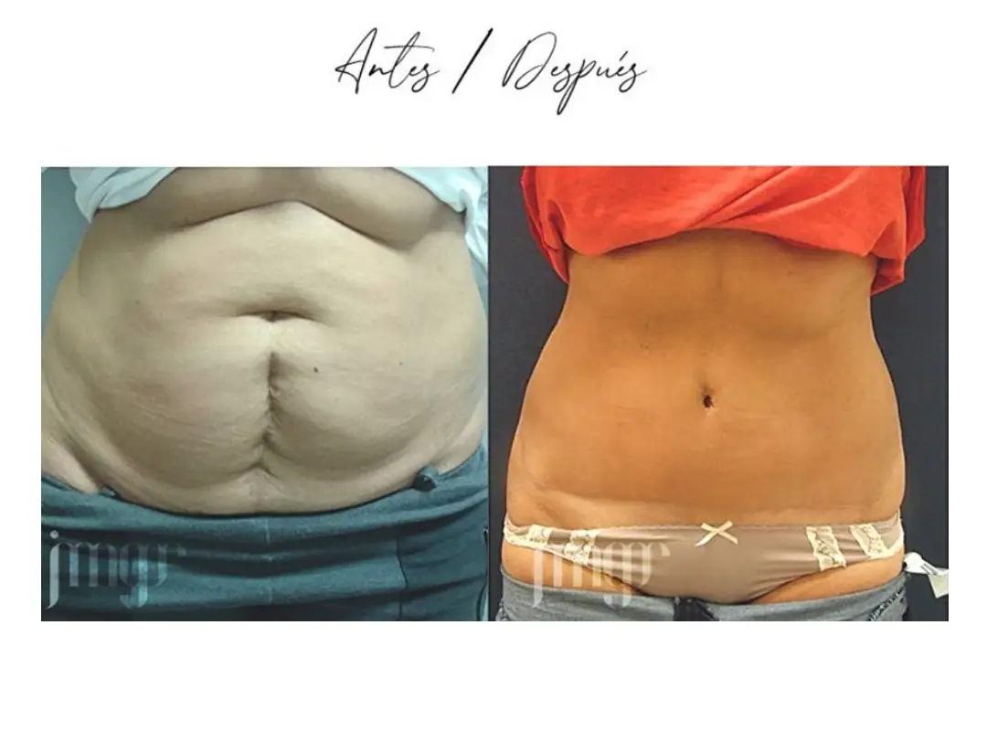 Abdominoplastia antes y despues (3) clinica eva almeria