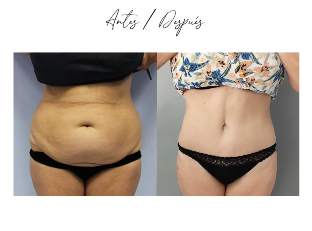 Abdominoplastia antes y despues clinica eva almeria