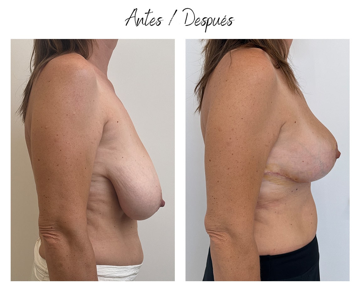 Mastopexia-Clinica-Eva-min