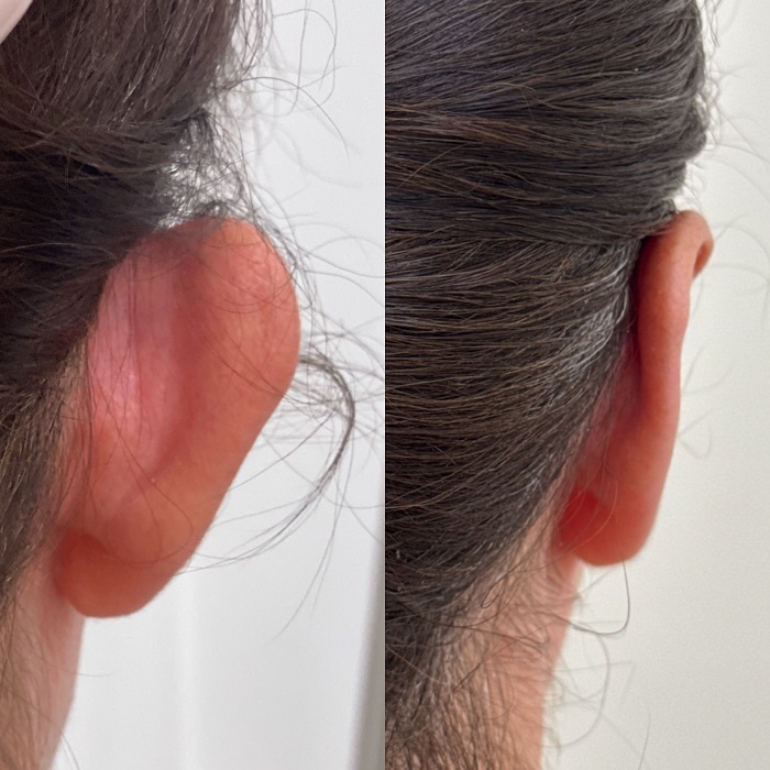 otoplastia Almeria clinica eva