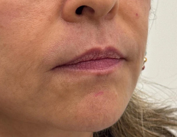 blanqueamiento odontologia aguadulce