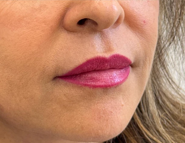 blanqueamiento odontologico aguadulce