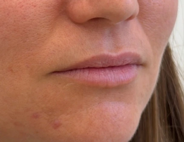 blanqueamiento odontologia aguadulce