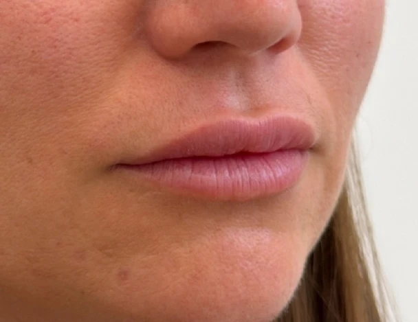 blanqueamiento odontologico aguadulce