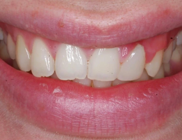 blanqueamiento odontologia aguadulce