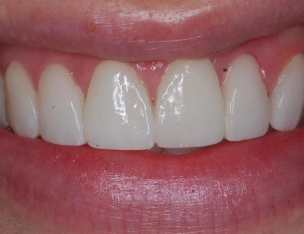 blanqueamiento odontologico aguadulce