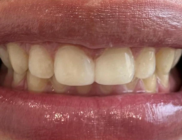 blanqueamiento odontologico aguadulce