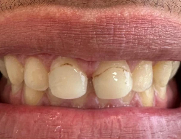 blanqueamiento odontologia aguadulce