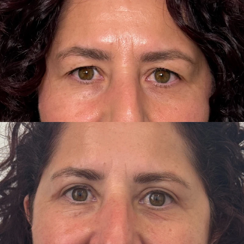 blefaroplastia realizada en almeria resultado