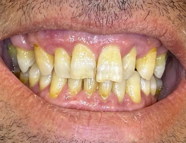 blanqueamiento odontologia aguadulce