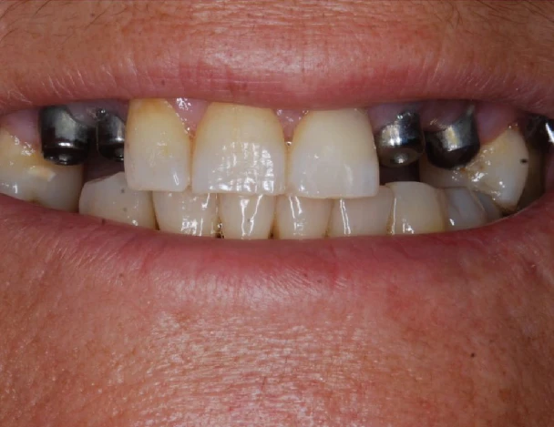 blanqueamiento odontologia aguadulce