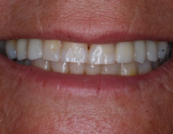 blanqueamiento odontologico aguadulce