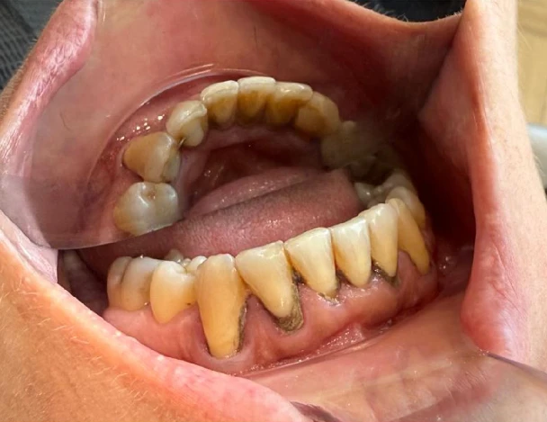 blanqueamiento odontologia aguadulce