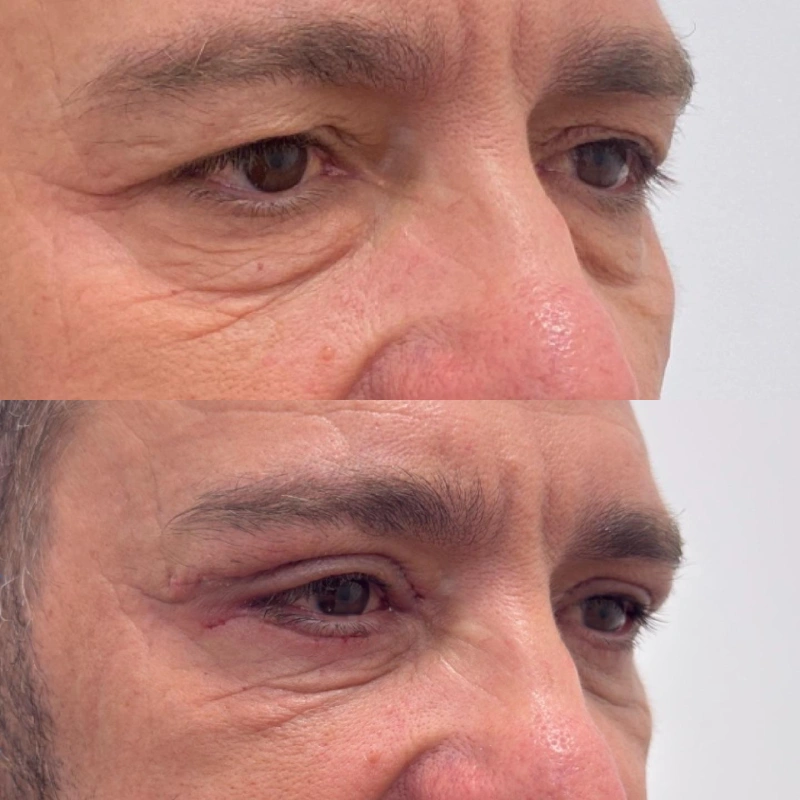 blefaroplastia hombre almeria clinica eva