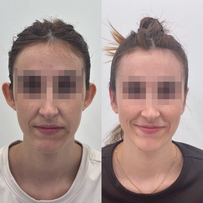 antes y despues de operacion otoplastia almeria