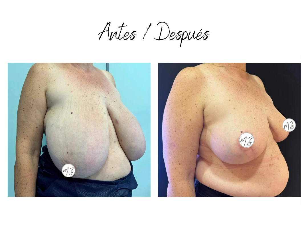 cirugia reduccion de pecho almeria