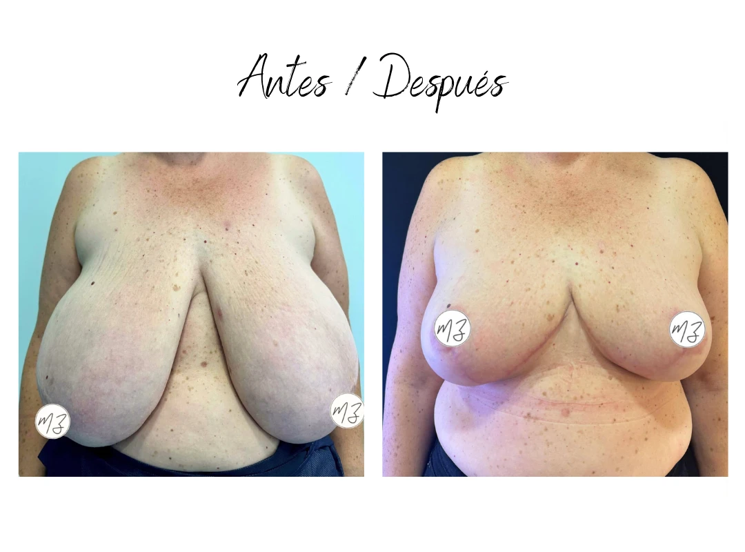 resultado reduccion de pecho almeria
