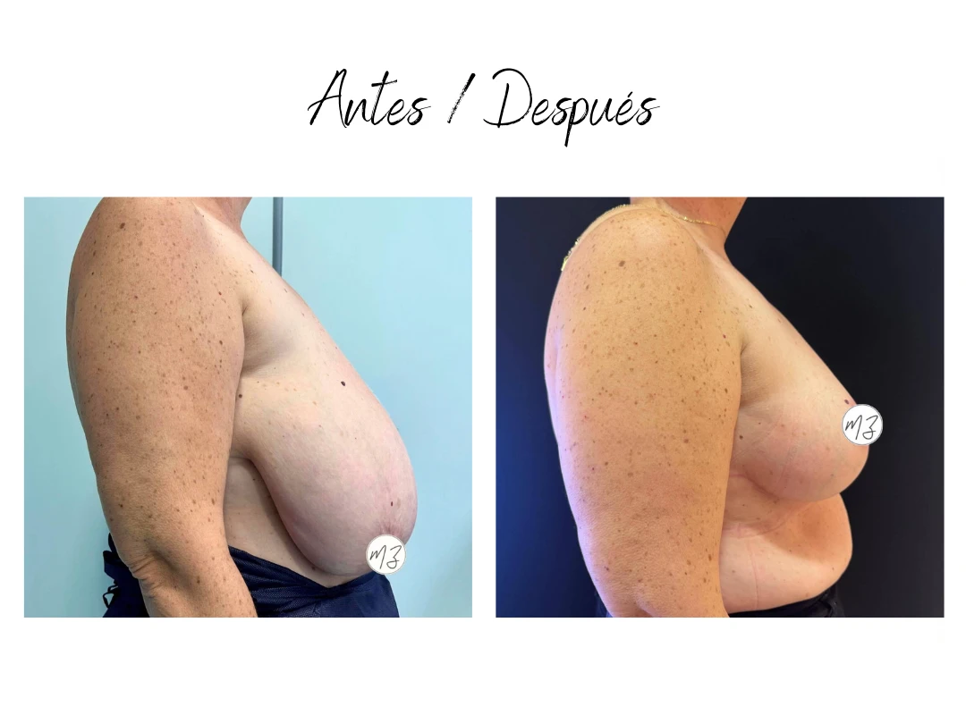 operacion reduccion de pecho almeria