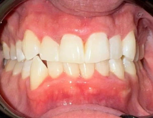 blanqueamiento odontologico aguadulce