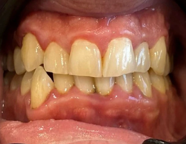 blanqueamiento odontologia aguadulce