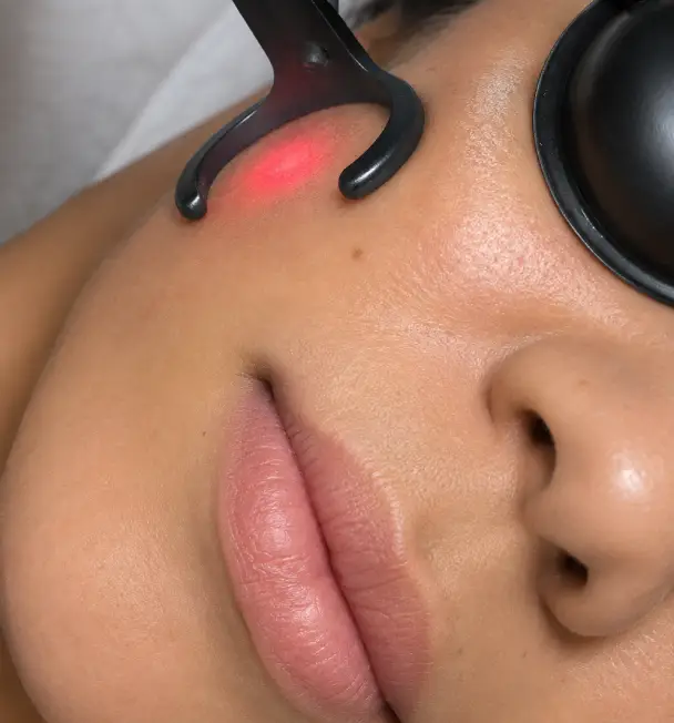 laser acne almeria aguadulce