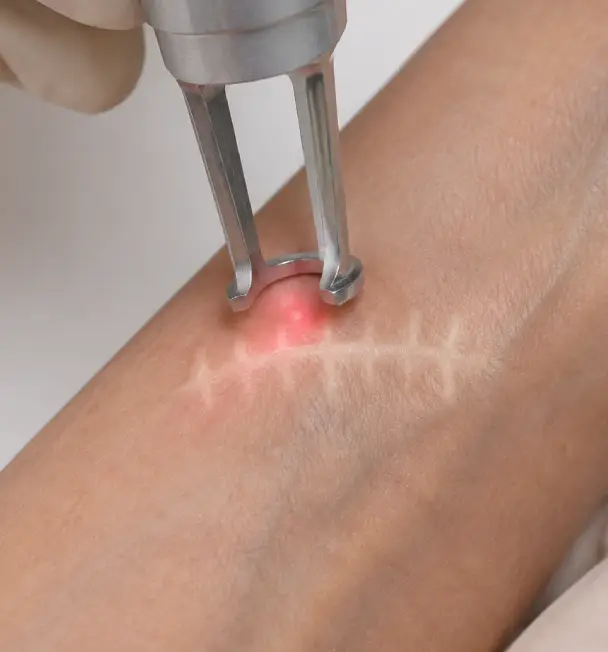 laser cicatrices almeria aguadulce