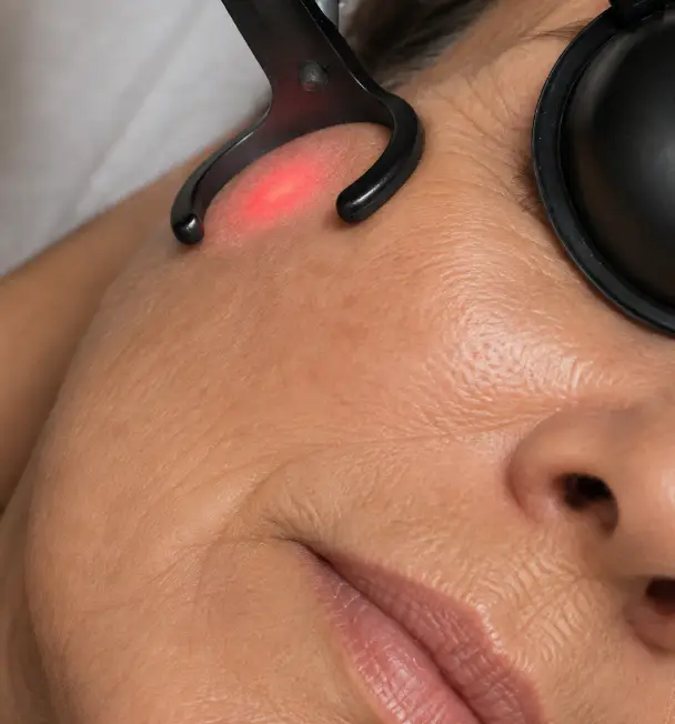 laser rejuvenecimiento facial almeria aguadulce
