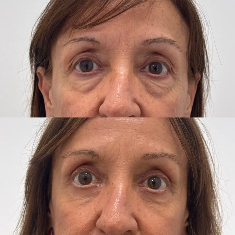 antes y despues blefaroplastia paciente almeria
