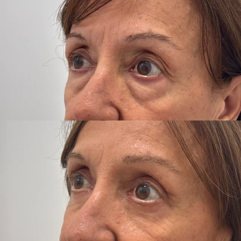 mejor cirujano blefaroplastia almeria