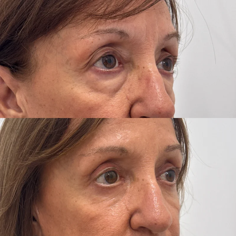 antes y despues mujer blefaroplastia almeria