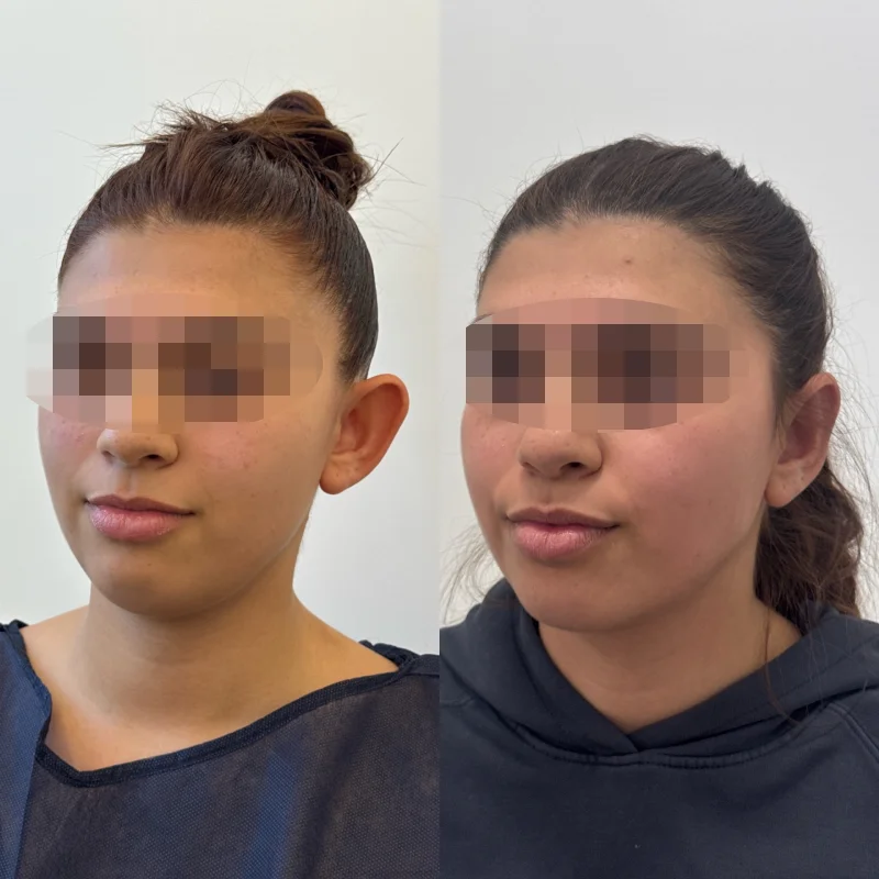 antes y despues otoplastia almeria chica