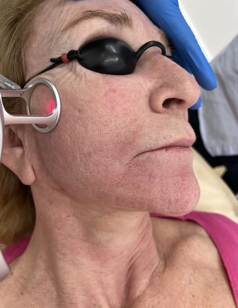 Láser CO2 facial en Almería