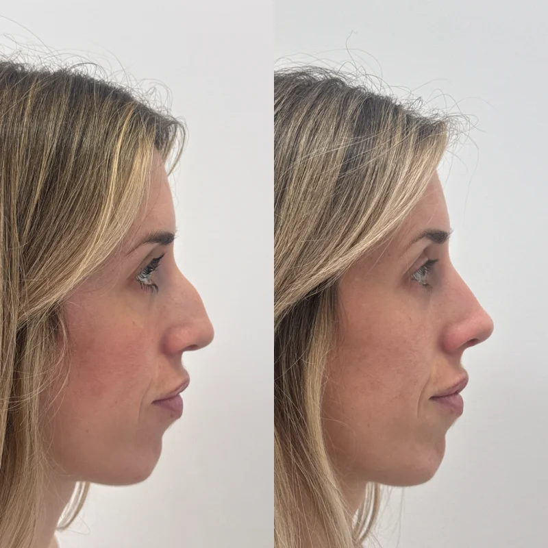 operación rinoplastia jiba Almería